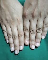 micronychia of the index finger