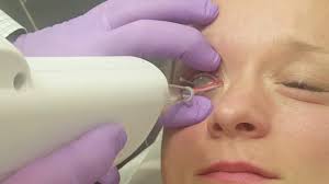 eyeliner laser tattoo removal by
