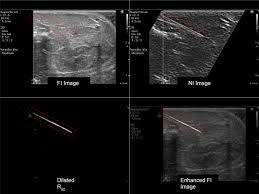 needle localization in ultrasound