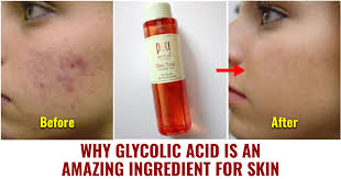 glycolic acid is a wonderful ing