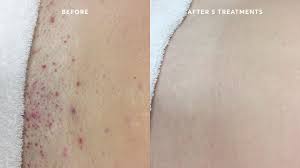 treatment i after laser hair removal