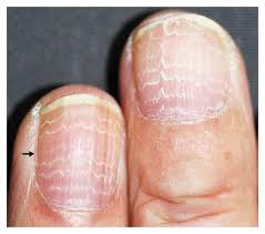 multiple white lines on the fingernails