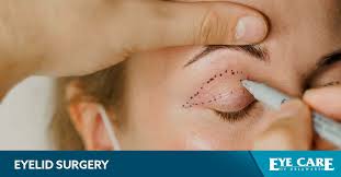 newark eyelid surgery upper and lower