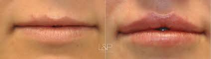 lip augmentation injections for palo