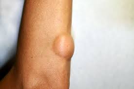 lumps under skin that move lipomas