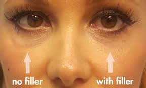 puffy under eyes after filler injection