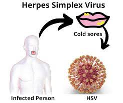 herpes simplex virus types causes
