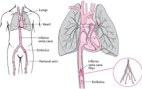 Pulmonary embolism (pe) is caused by a blood clot that becomes lodged in the pulmonary artery, the main blood vessel leading to the lungs, or one of its branches. Pulmonary Embolism Pe Lung And Airway Disorders Merck Manuals Consumer Version