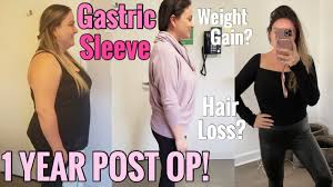 gastric sleeve surgery 1 year post op