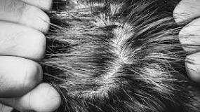 is-dry-scalp-permanent