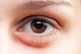 swollen eyes reason and how to