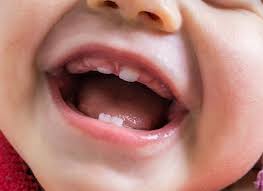 Bayi akan sering mengunyah benda keras, lebih sering itu dia lima tanda bayi tumbuh gigi yang patut mama kenali. Dokter Gigi Condet