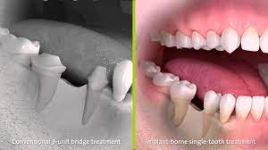dental bridge costs typeore uk