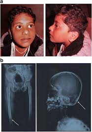 Epicanthal folds are formed due to the excess growth and development of the skin over the nasal bridge. A Case Of Raine Syndrome Presenting With Facial Dysmorphy And Review Of Literature Bmc Medical Genetics Full Text