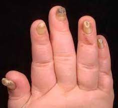 nonsyndromic con nail disorder