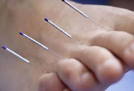 Image result for acupuncture needles on the finger joints