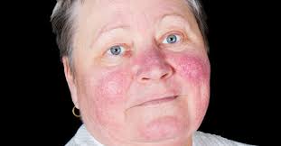 malar rash causes symptoms and treatment