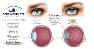 cataract surgery procedure safety