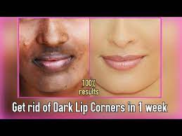 remove dark lip corners
