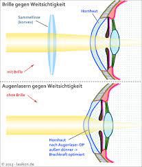 Augen lasern altersweitsichtigkeit