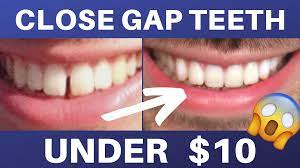 For adults, or children with gaps that do not close, there are a number of other causes. How To Close Gap Teeth At Home Diy 10 Gap Teeth Fix Teeth Teeth