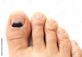 bruise on big toe nail stock photo