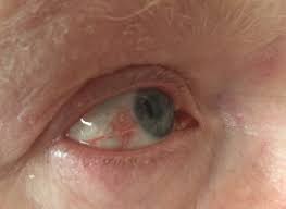 shingles on forehead and in the eye