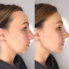 nose job in cheshire dermal fillers