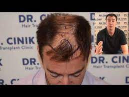 dr cinik hair transplant doctor in turkey