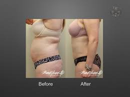 liposuction in new orleans body