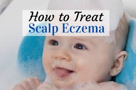 how to treat scalp eczema in es