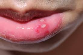 canker sores and fever blisters