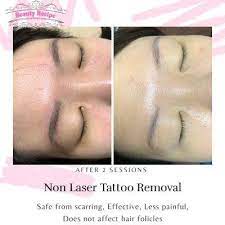 non laser tattoo removal phi brows