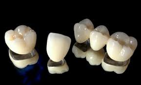 What Is A Pfm Dental Crown News Dentagama