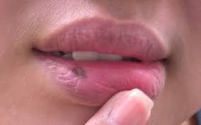 lip pigmentation treatment in singapore