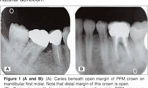 Figure 1 From Porcelain Fused To Metal Pfm Crowns And