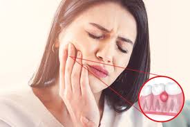 what are dental abscesses miami fl