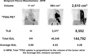 Treatment for stage iii relies more on pain relief and ensuring the patient is comfortable. 18f Fdg Pet Assessment Of Malignant Pleural Mesothelioma Total Lesion Volume And Total Lesion Glycolysis The Central Role Of Volume Journal Of Nuclear Medicine