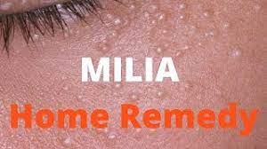milia treatment you