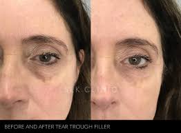 Issues in this area are often are associated with looking tired. Under Eye And Tear Trough Filler In Nashville Tennessee