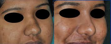 rhinoplasty kerala india cosmetic nose