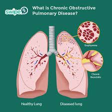 Related online courses on physioplus. What Is Copd Swiperx