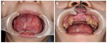 a case of a giant sublingual epidermoid