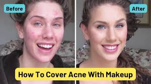foundation routine for acne how to
