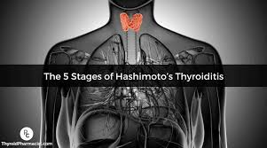 the 5 ses of hashimoto s thyroiditis