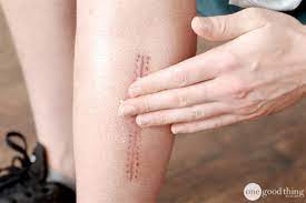 home remes to heal scars naturally