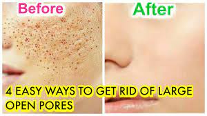 open pores naturally at home remes