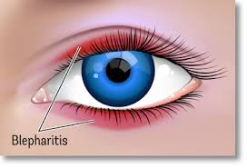 best eye treatments for blepharitis and