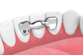 how long do dental bridges last