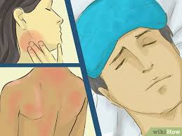 3 ways to treat a chemical burn wikihow